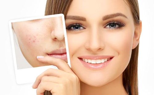 Como eliminar cicatrices de acné rápido : Los tratamientos más eficaces !