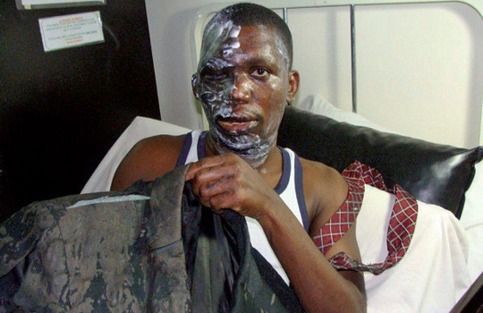 Pastor Mulinde Umar, con quemaduras graves tras ser atacado por musulmanes en Uganda