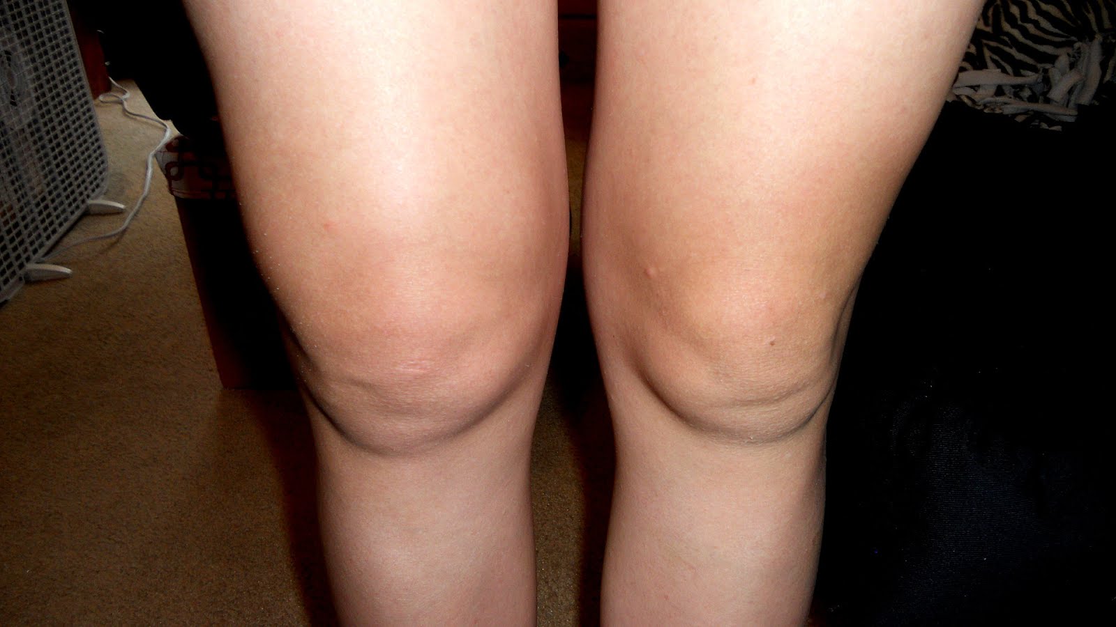 what causes knee swelling