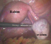 Diagnosis dan pengobatan sindroma Ovarium Polikistik info kesehatan indonesia