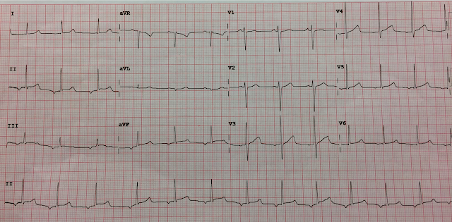 ivcd ecg measurement ivcd ecg measurement