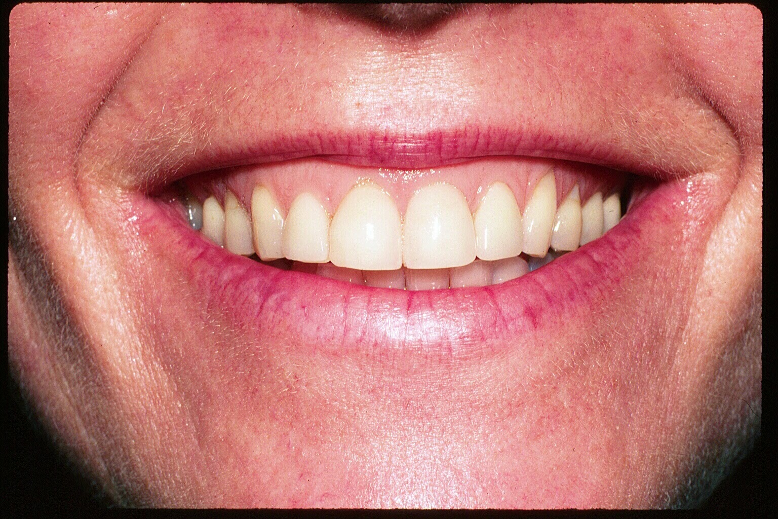 Dr. Robert G. Tupac: Prosthodontics: Picture Perfect Smile With Veneers