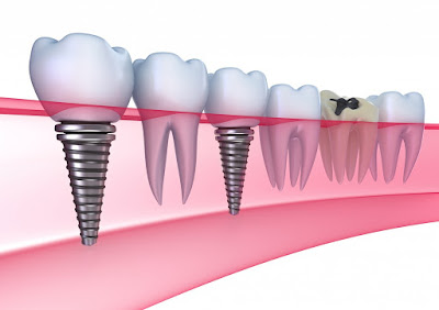 Quy trình cấy ghép răng implant cho hiệu quả cao