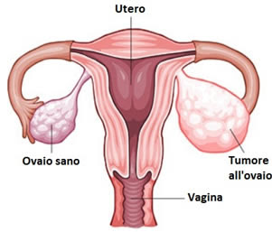 Carcinoma ovarico
