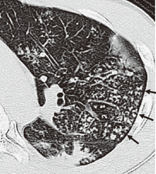 大垣市民病院 呼吸器内科 treeinbud appearance