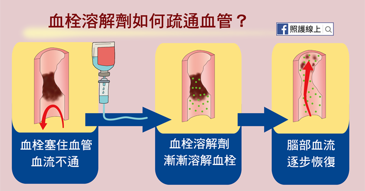 中風該怎麼治療?(懶人包) - 照護線上 中風該怎麼治療?(懶人包) - 照護線上