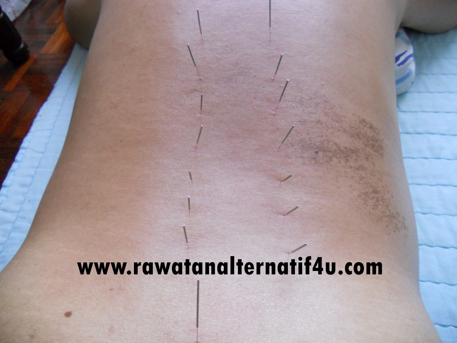 Merawat Masalah Sakit Pinggang