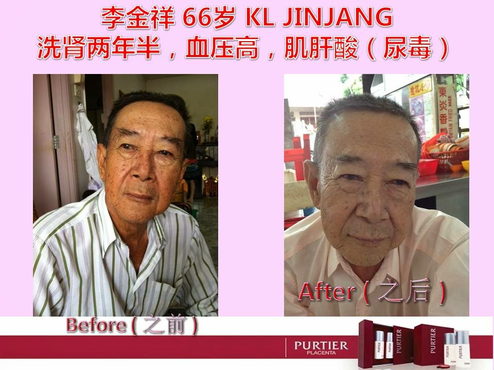 LEE KIM SEONG (66) KL JINJANG - DIALYSIS FOR 2 YEARS, HYPERTENSION, CREATININE (UREA)