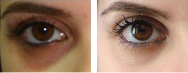 prp for dark circles