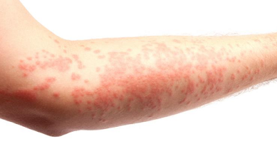 Dermatitis atau Alergi Kulit