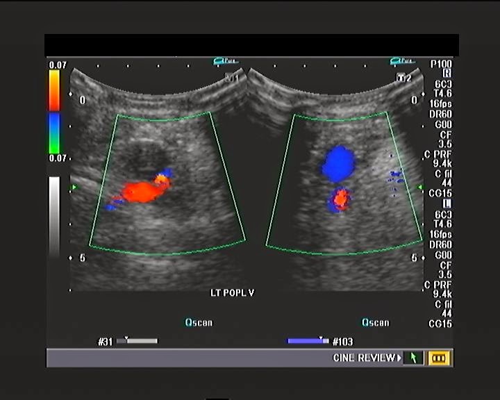 A patient of calf and leg pain venous Doppler study Ultrasound Cases