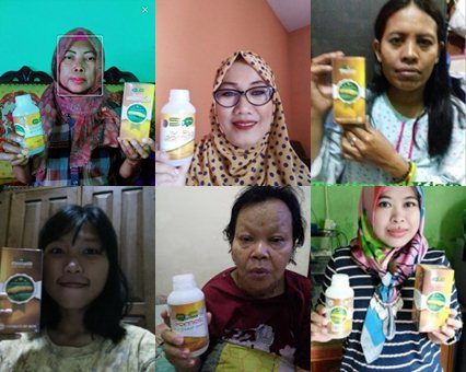 Cara Menghilangkan Benjolan Keloid Secara Alami dan Cepat ~ TESTIMONI QNC JELLY GAMAT Cara Menghilangkan Benjolan Keloid Secara Alami dan Cepat ~ TESTIMONI QNC JELLY GAMAT