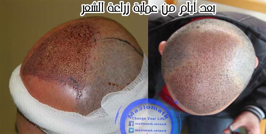 تقرير كامل عن زراعة الشعر %D8%A8%D8%B9%D8%AF%2B%D8%A7%D9%8A%D8%A7%D9%85