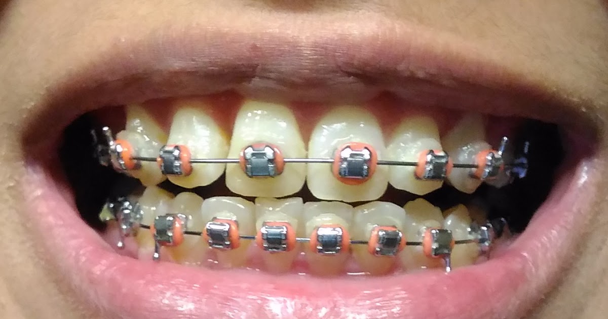 Pengalaman Setahun Dua Bulan dengan Braces fatimahnabila