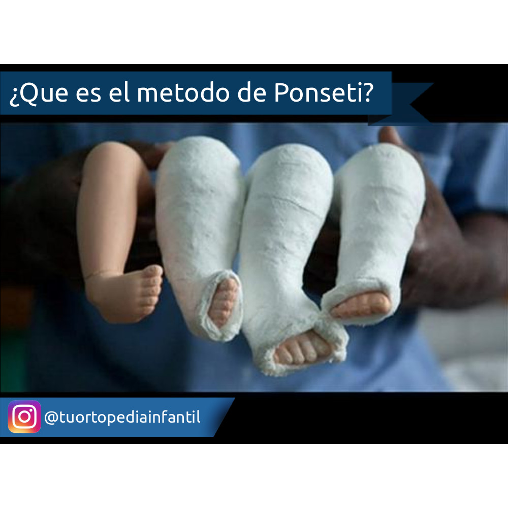 El Método de Ponseti