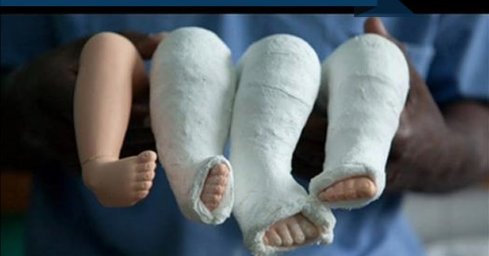 El Método de Ponseti