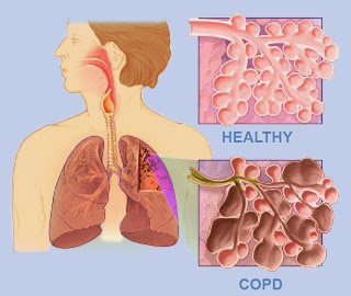 penyakit paru-paru