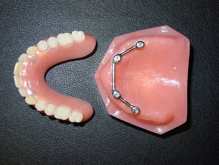 Antoine PetitBreuilh, Especialista en Implantología y