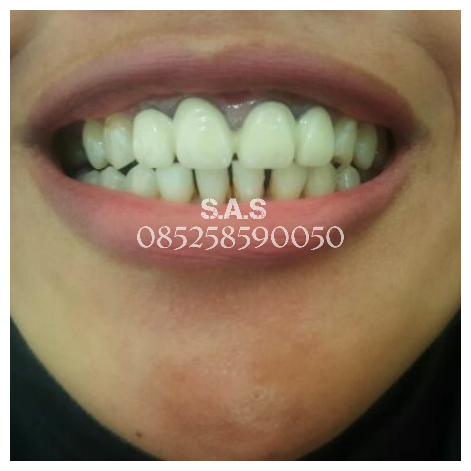 Gambar Crown Bridges Gigi Sehat Mahkota Porselen Geraham Bridge