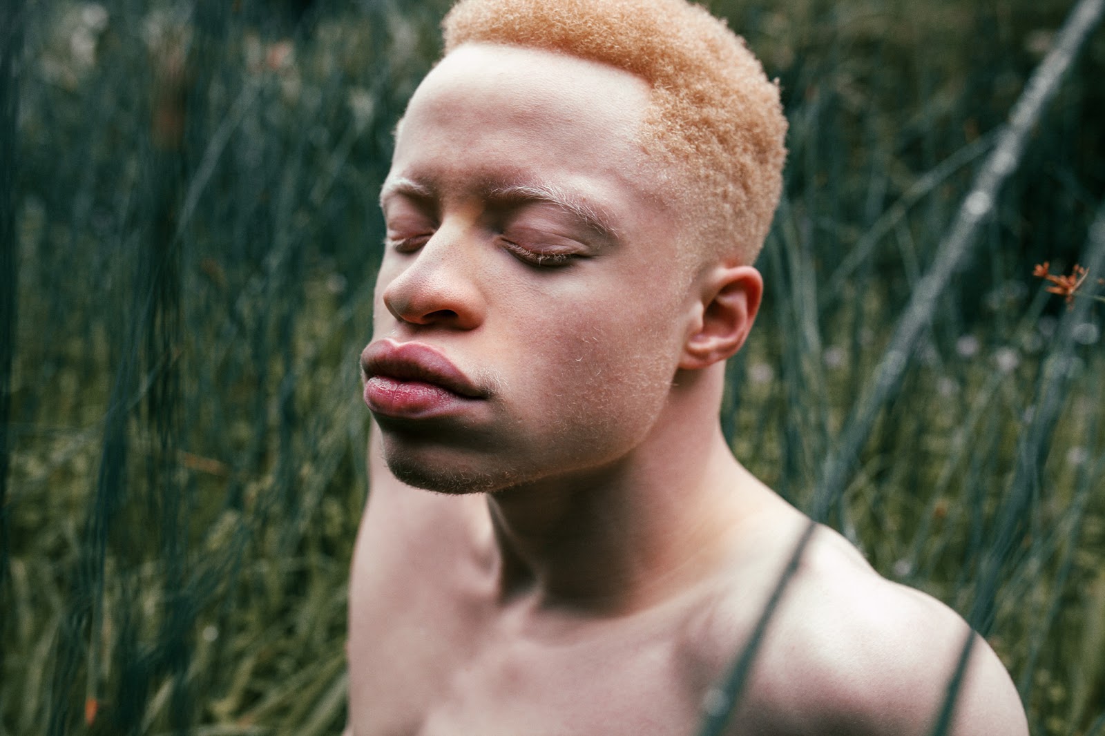 Белый негр. Альбинос негроидной расы. Глазокожный альбинизм 3 ГКА 3. Афроазиат альбинос.