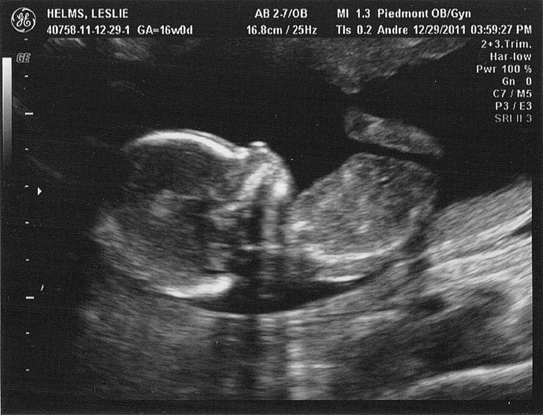 16 недель беременности можно узнать пол. УЗИ 16 недель беременности УЗИ. 16 Недель беременности фото ребенка на УЗИ. УЗИ В 16 недель беременности фото УЗИ. УЗИ ребенка на 15 неделе беременности.