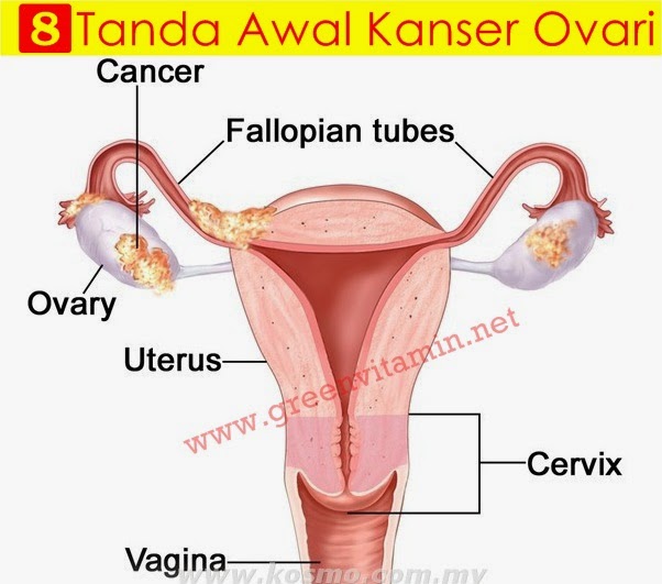 8 Tanda Tanda Awal Anda Menghidap Kanser Ovari Iluminasi
