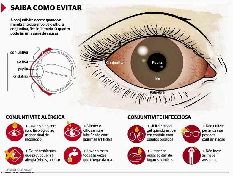 Centopéia Chic Conjuntivite Saiba diferenciar os 3 tipos Viral, Bacteriana e Alérgica