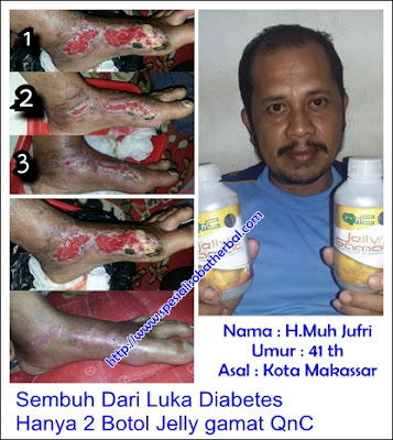 Cara Menyembuhkan Jerawat Bernanah Dengan Cepat Cara Menyembuhkan Jerawat Bernanah Dengan Cepat