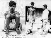 Small Pox in India