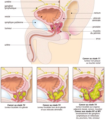 Terápiás eljárás a prosztatitisben mi a prosztatagyulladás és annak jelei