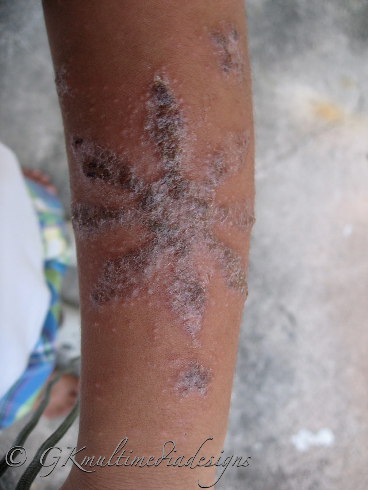 Anything Under The Sun: Beware of Henna Tattoo Allergy