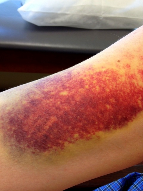 [Image: the+bruise.JPG]