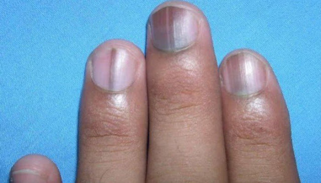 Darkening of the nail bed due to vitamin deficiency - wide 7