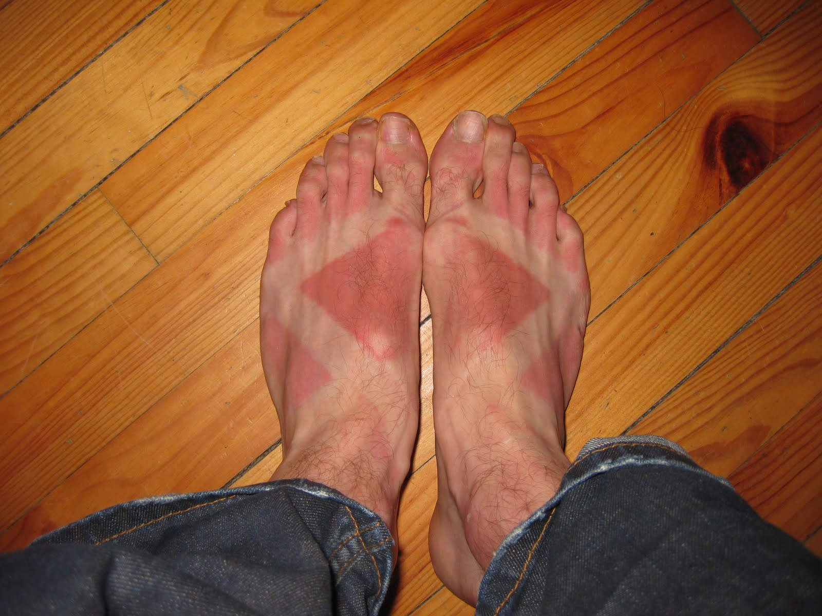 Sunburn Foot Pain Houston Podiatrist Tanglewood Foot Specialists