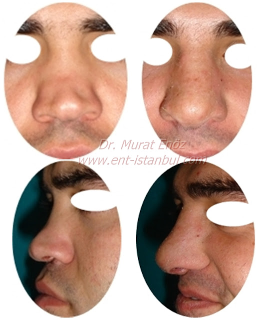 Revision nose aesthetic surgery - Secondary rhinoplasty - Revision nose job in Istanbul - Secondary nose job in Turkey - Secondary nose cosmetic surgery - Tertiary rhinoplasty - Secondary rhinoplasty challenges - Revision rhinoplasty using rib cartilage