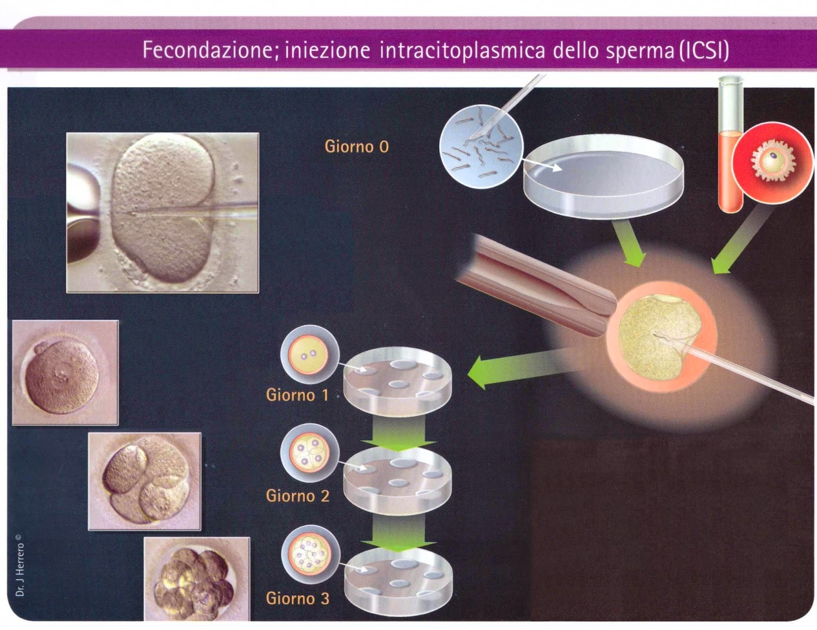 ICSI - INIEZIONE INTRACITOPLASMATICA DI SPERMATOZOI