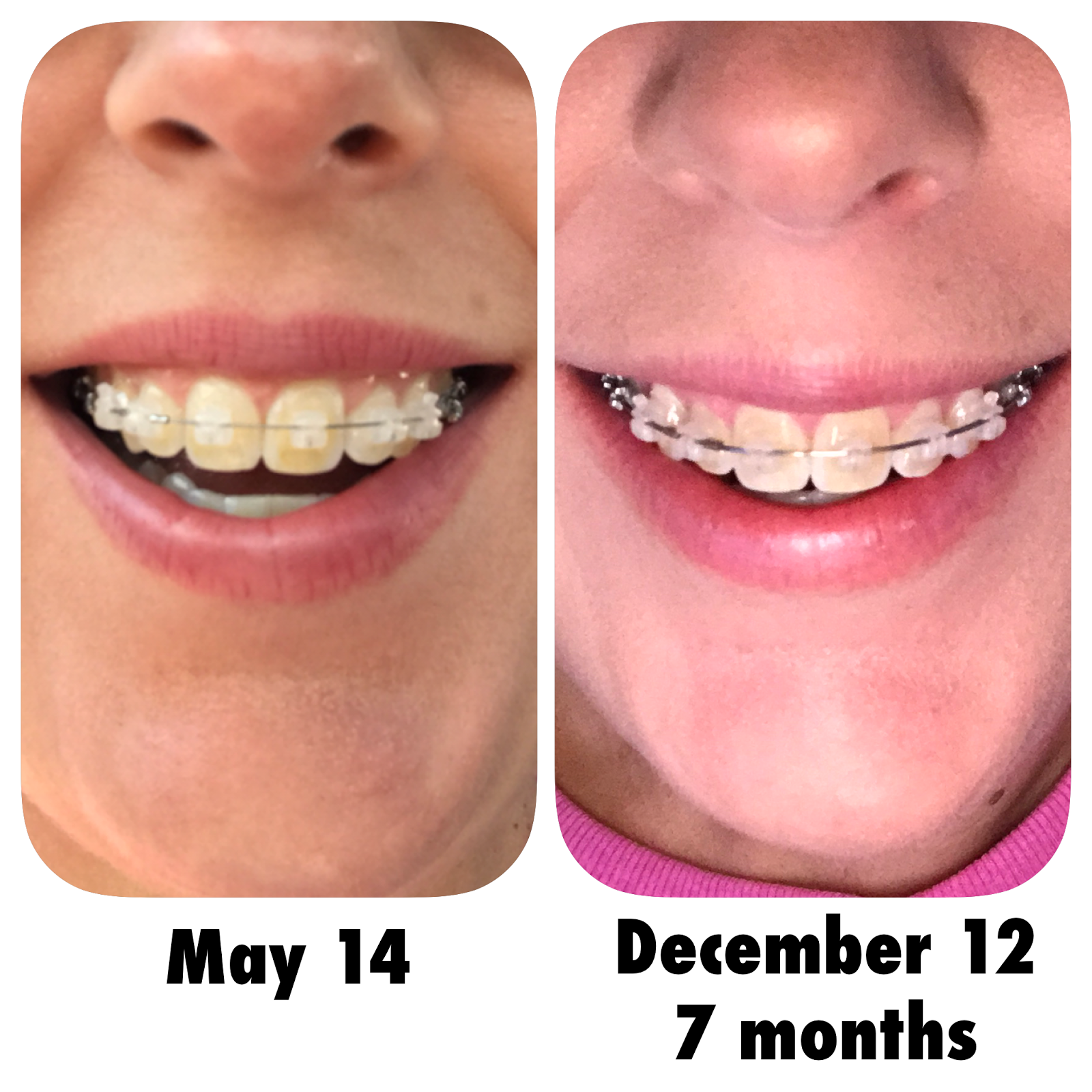 My Fashionable Designs Adult Braces I got braces....again!