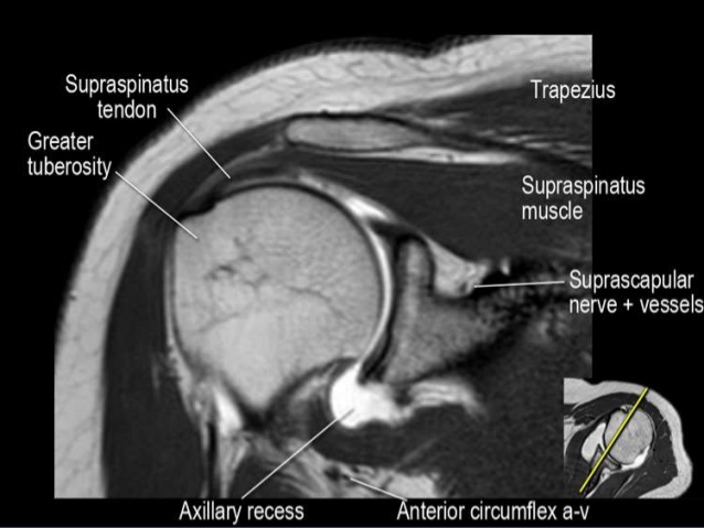 MRI Musculo-Skeletal Section: MRI anatomy of the shoulder (coronal view)