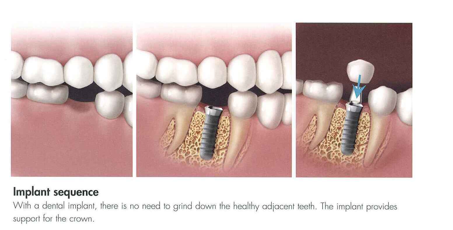 Dental Implants Dentist The Only Solution For That Broken And Damaged