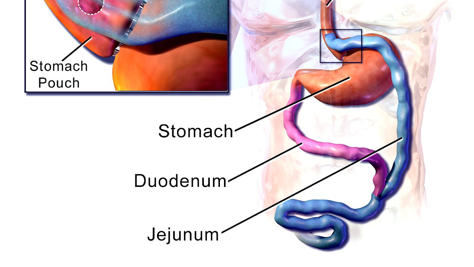 Gastric Bypass And Ulcers Ulcer Choices