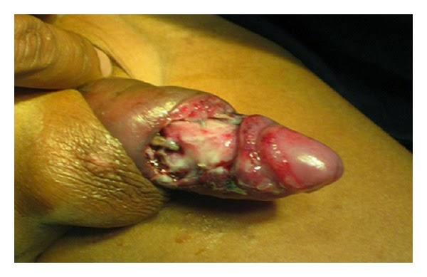 Wound Penis 39