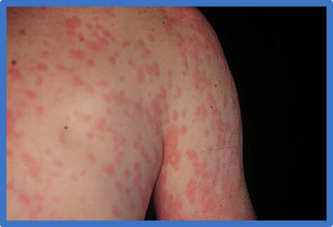100 Gambar Alergi Henna Kekinian