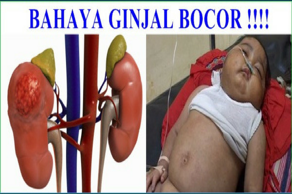 Waspada! Bayi Anda Bisa Terserang Gagal Ginjal Jika Pernah Mengalami Gejala ini Waspada! Bayi Anda Bisa Terserang Gagal Ginjal Jika Pernah Mengalami Gejala ini