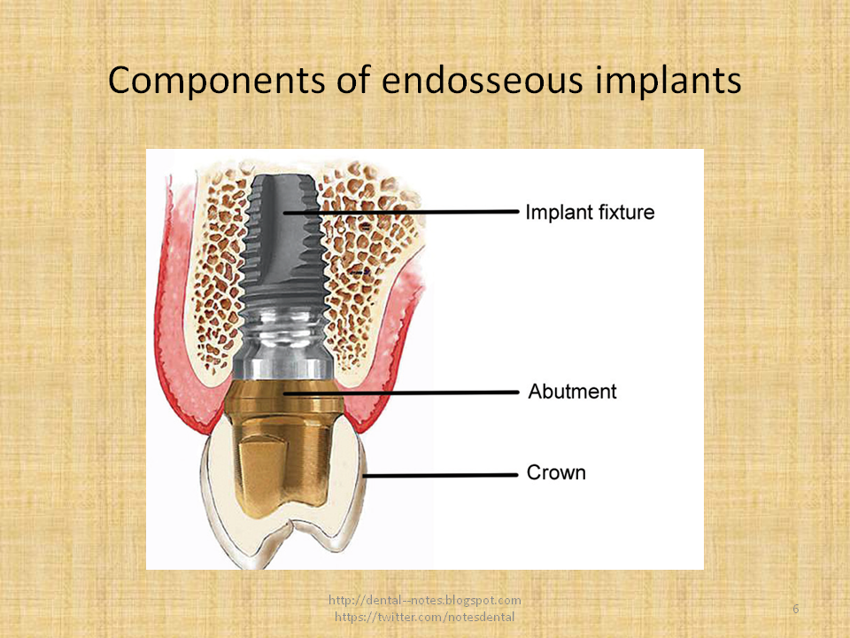Dental Notes Dental Implant Materials NOTES (new)