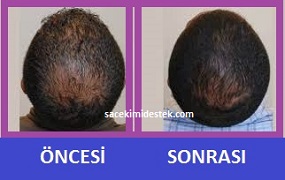 saç mezoterapisi öncesi ve sonrası 14