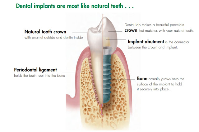 http://www.implantdentistindia.com/need-of-implant/