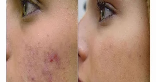 FunkiRide: Acne Scars Removal Tips