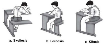 Kelainan tulang belakang seperti pada gambar, disebut.