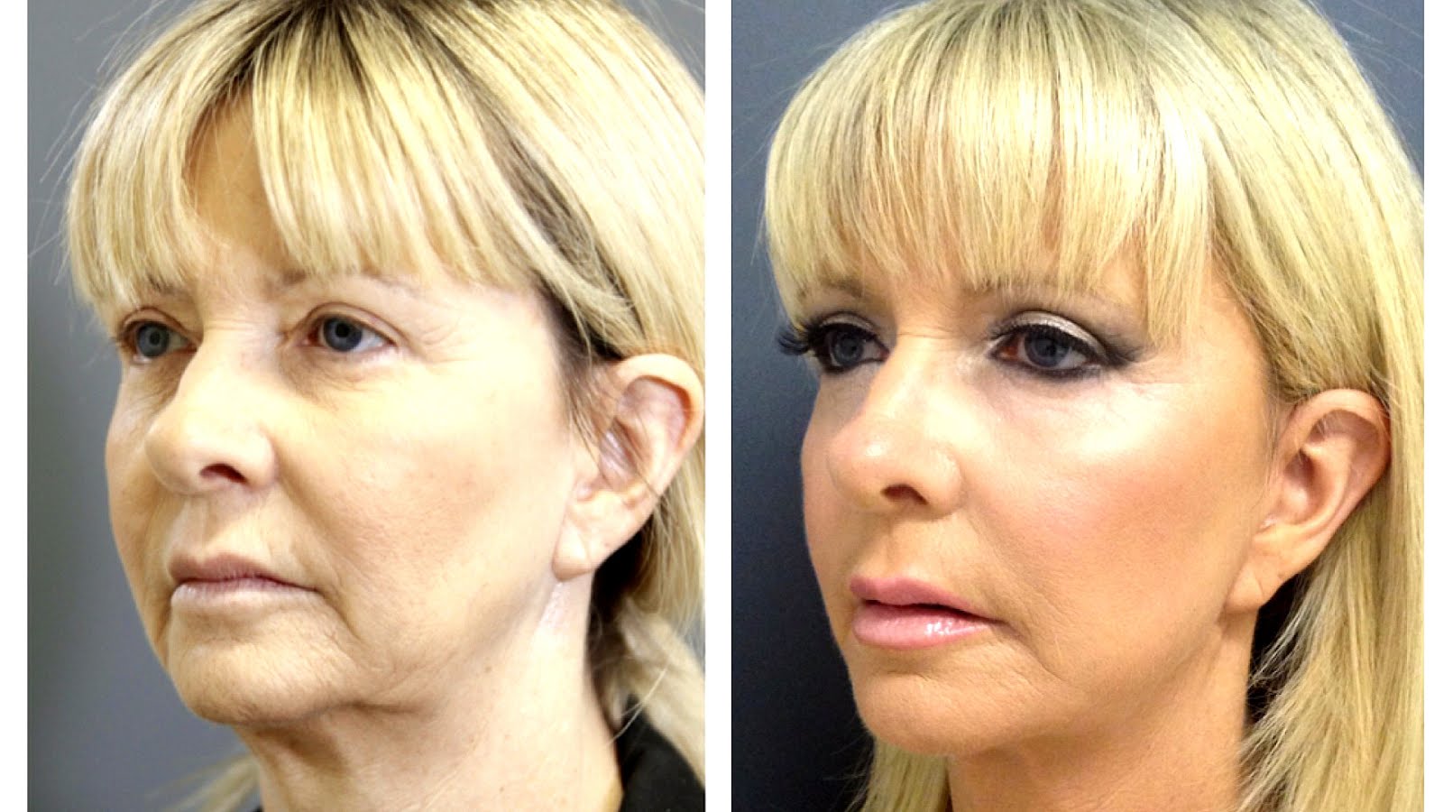 Lower Mini Face Lift Lift Choices