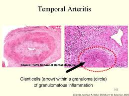 arteritis de horton